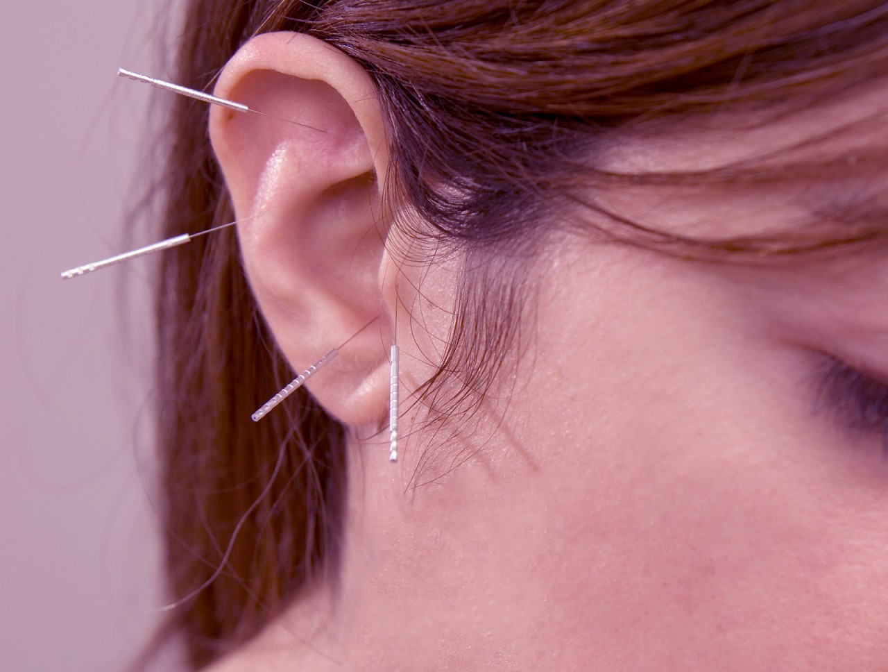 O que é a acupuntura auricular?